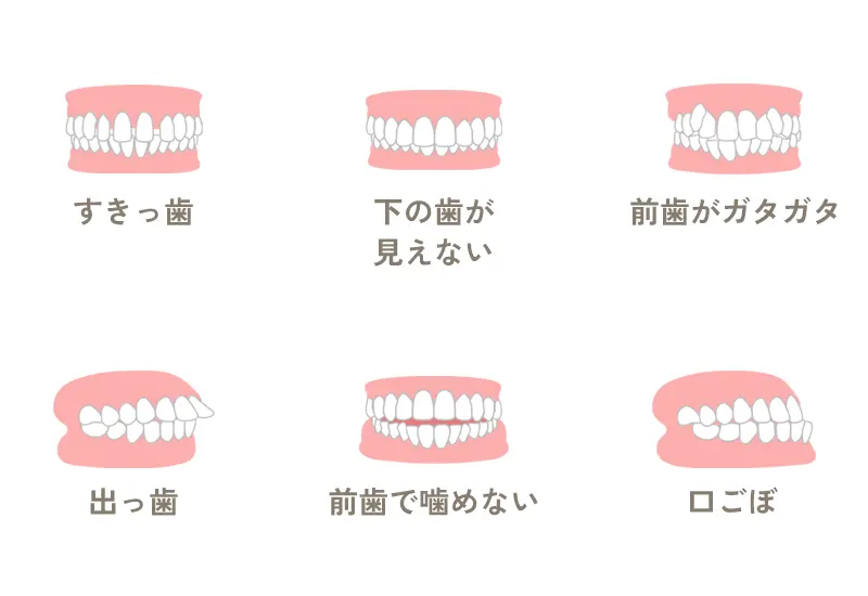 不正咬合